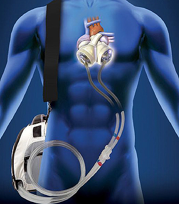 Corazón Artificial Total Syncardia Fuente: Clínica Universidad de Navarra