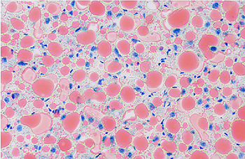 Tinción en secciones de hígado de ratón. Muestran la esteatosis del hígado (hígado graso), con acumulación de grasas, gotas de lípidos en rojo, dentro de las células. En azul, los núcleos celulares (C Maíllo, IRB Barcelona) Fuente: IRB Barcelona