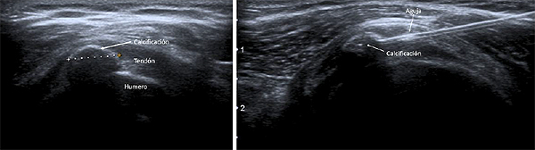La ecografía de la izquierda muestra una tendinitis calcificante en el hombro y la de la izquierda, la intervención guiada por ecografía usando una aguja para aspirarla y eliminarla Fuente: SERAM / SERME / docorcomunicacion