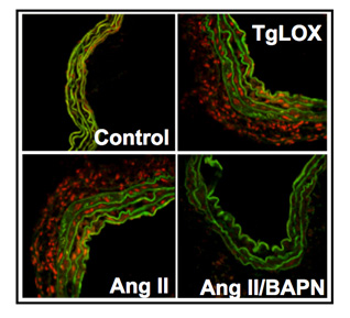 Las arterias de ratones que sobre-expresan lisil oxidasa (TgLOX) muestran mayores niveles de estrés oxidativo (tinción roja) que los animales control. El aumento del estrés oxidativo observado en un modelo de hipertensión arterial por infusión de Angiotensina II, se reduce drásticamente en presencia de un inhibidor farmacológico de la lisil oxidasa (BAPN).  Autoría de la imagen: UAM-ICCC-CSIC Fuente: UAM-ICCC-CSIC / Centro de Investigación Biomédica en Red (CIBER)