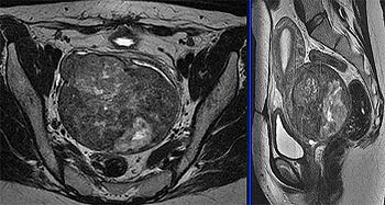 En las imágenes se ve la cavidad uterina con diferentes densidades, que es el tumor endometrial Difusión: SEOM (Archivo)