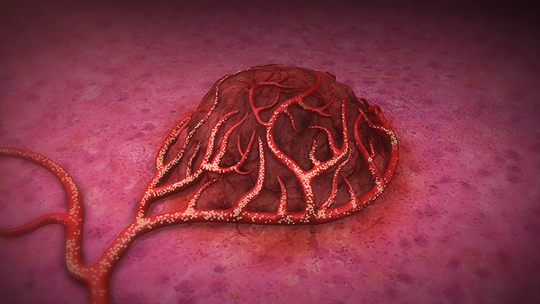 Las microesferas de resina SIR-Spheres Y-90 son llevadas directamente al tumor por el suministro de sangre arterial Fuente: Sirtex / Berbés Asociados