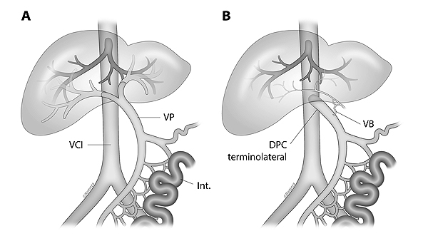 Imagen hígado normal (izq.) vs malformación Abernethy Fuente: Hospital Vall d’Hebron 