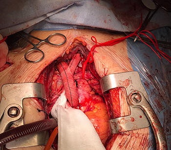 By-pass de aorta que revascularizaba los grandes troncos supra-aórticos Fuente: Dr. Fernández Caballero / Hospital de Torrejón