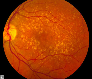 Fondo de ojo que muestra una degeneración macular intermedia Fuente: National Eye Institute of the NIH, http://www.nei.nih.gov/photo/eyedis/images/EDA22_72.jpg Wikipedia 