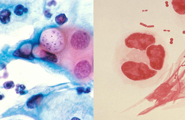IMAGEN DE LA IZQUIERDA Extendido Pap mostrando a ‘C. trachomatis’ (Tinción H&E). Clamidiasis Title: Pathology: Histology: Pap Smear Description: Human pap smear showing clamydia in the vacuoles at 500x and stained with H&E. Subjects (names): Topics/Categories: Pathology -- Histology Type: Color Slide Source: Dr. Lance Liotta Laboratory Author: Unknown photographer/artist AV Number: AV-8803-3302 Date Created: March 1988 Date Entered: 1/1/2001 Access: Public. http://visualsonline.cancer.gov/details.cfm?imageid=2331. Detalles de permisos PD Fuente. Wikipedia IMAGEN DE LA DERECHA ‘Neisseria gonorrhoeae’, agente causal de la gonorrea Autoría de la imagen: Photo Credit: Content Providers(s): CDC/ Dr. Norman Jacobs - This media comes from the Centers for Disease Control and Prevention's Public Health Image Library (PHIL), with identification number #3693. Note: Not all PHIL images are public domain; be sure to check copyright status and credit authors and content providers. English | Slovenščina | +/− Fuente: Wikipedia 