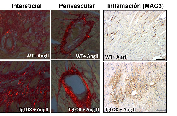 Figura: En el miocardio de los ratones transgénicos para la lisil oxidasa (TgLOX), la administración de Angiotensina II (AngII) aumenta el nivel de colágeno maduro (visualizado como refringencia roja) frente a los animales normales (WT). Los animales transgénicos presentan además mayor inflamación (paneles de la derecha) Fuente: CIBERCV / CIBER