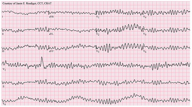 Electrocardiograma de una fibrilación ventricular Autor/a-Fuente de la imagen: Jer5150 Fuente: Wikipedia 