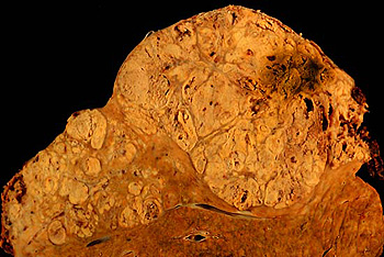 Carcinoma hepatocelular Autor/a de la imagen: Ed Uthman, MD Fuente: http://web2.airmail.net/uthman/specimens/index.html / Wikimedia Commons