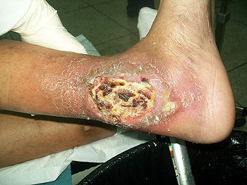Úlcera en un pie diabético Úlcera en un pie diabético Autor/a de la imagen: Bobjgalindo Fuente: Wikimedia Commons