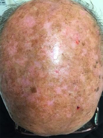 Imagen 3. Paciente con múltiples queratosis actínicas en cuero cabelludo (campo de cancerización) Fuente: Dr. Javier J. Domínguez 