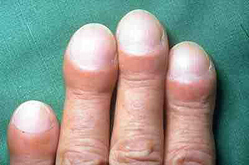 Dedos hipocráticos en la mano de un paciente con FPI Autor/a de la imagen: IPFeditor (Trabajo propio) Fuente: Wikipedia 