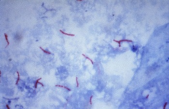 ‘Mycobacterium tuberculosis’ (causante de la tuberculosis): visualización con el uso de la tinción de Ziehl Neelsen Autor/a de la imagen: CDC/Dr. George P. Kubica - phil.cdc.gov CDC-PHIL ID #5789 This photomicrograph reveals Mycobacterium tuberculosis bacteria using acid-fast Ziehl-Neelsen stain; Magnified 1000 X. The acid-fast stains depend on the ability of mycobacteria to retain dye when treated with mineral acid or an acid-alcohol solution such as the Ziehl-Neelsen, or the Kinyoun stains that are carbolfuchsin methods specific for M. tuberculosis Fuente: Wikipedia 