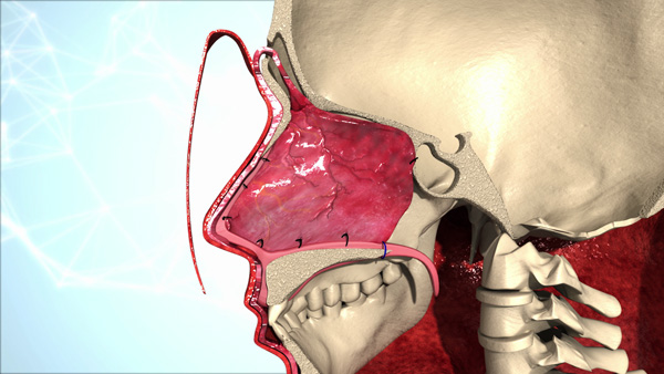 El colgajo pericraneal, previamente obtenido del cráneo, ha sido implantado a través de una ranura efectuada sobre la nariz, ocupando ya la cavidad nasal Fuente: Hospital Clínic 