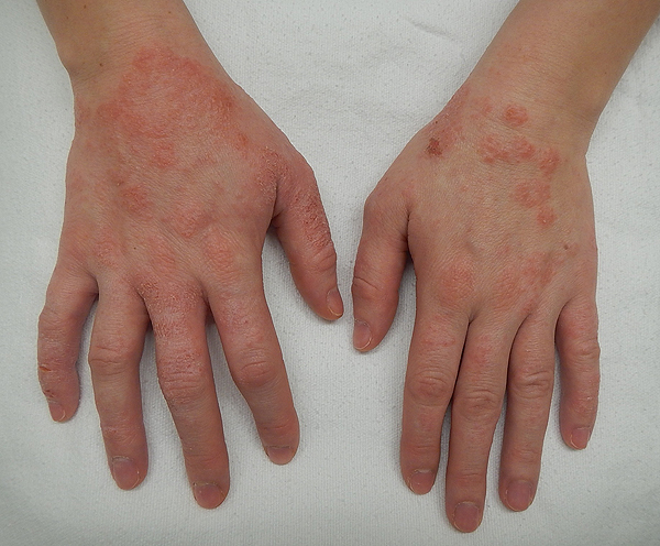 Dermatitis o eccema en manos Autor/a de la imagen: James Heilman, MD Fuente: Wikimedia Commons