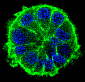 Crecimiento acinar de células tumorales en el modelo 3D de microambiente tumoral en hidrogeles de red interpenetrante Fuente: CIBERONC / Centro de Investigación Biomédica en Red (CIBER) 