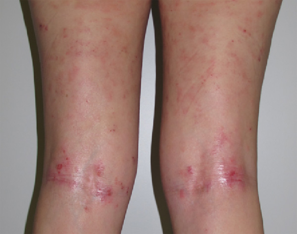 Un caso de dermatitis atópica Fuente: cortesía de la Dra. Serra-Baldrich Hospital Sant Pau. Dermatología 