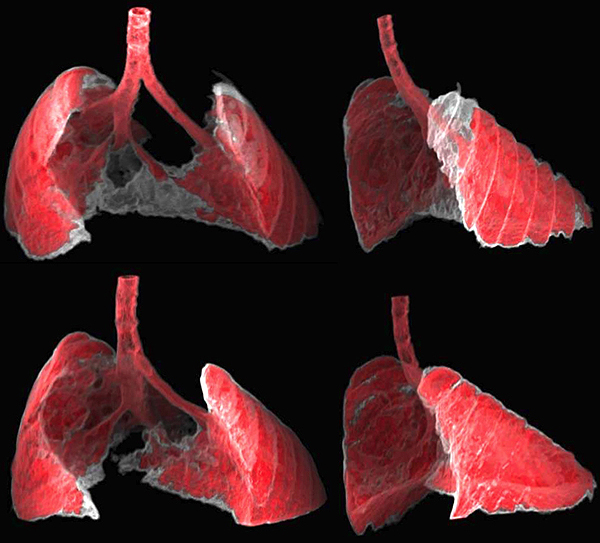 La figura muestra dos vistas, frontal y lateral, de la imagen obtenida por TAC de los pulmones de un ratón con fibrosis (zonas grises) antes y después de ser tratado con nanoterapia dirigida a las células senescentes. Las células senescentes son en parte responsables de la fibrosis pulmonar (Guillermo Garaulet y Francisca Mulero, CNIO) Fuente: IRB Barcelona