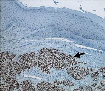 Carcinoma de células de Merkel (flecha) infiltrando el tejido cutáneo; se muestra en tono café la cadena de proteína T del Poliomavirus de las células de Merkel Autor/a de la imagen: Patrick S. Moore (original creation) Fuente: Wikipedia