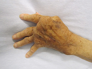 Mano afectada por la artritis reumatoide Autor/a de la imagen: James Heilman, MD - Trabajo propio Fuente: Wikipedia 