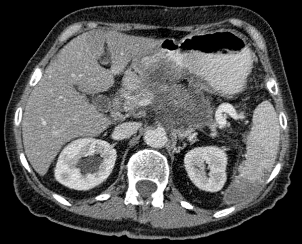 Cáncer de páncreas en tomografía computada Autor/a de la imagen: Hellerhoff  Fuente: Viquipèdia / Wikipedia
