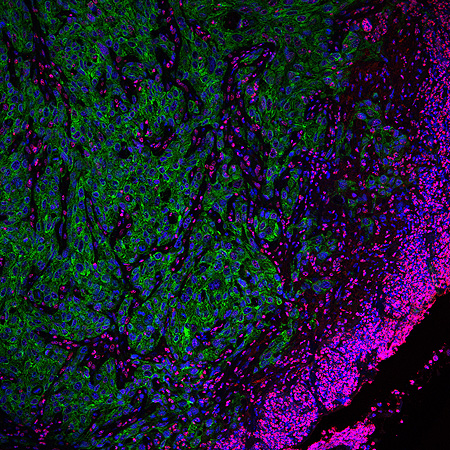 Frente de células tumorales invasivas (en verde). Imagen de microscopía confocal  Autora de la imagen: Alexandra Avgustinova, IRB Barcelona) Fuente: IRB Barcelona 