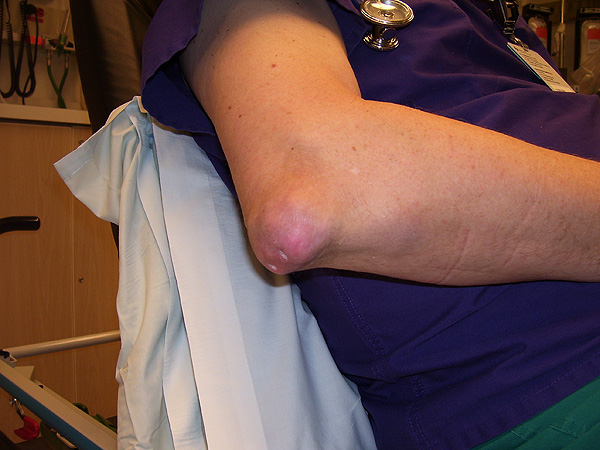 Tofo localizado en el codo de un paciente con gota Autor/a de la imagen: NickGorton - NickGorton Fuente: Wikipedia