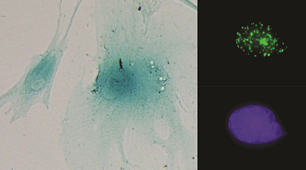 Imágenes de dos células senescentes (izquierda). A la derecha, un núcleo celular mostrando foco de daño al ADN (arriba) y su control (abajo) Fuente: CIBERONC / Centro de Investigación Biomédica en Red (CIBER)  