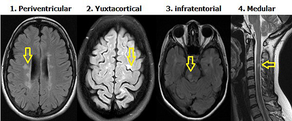 Esclerosis múltiple. Localización más frecuente de lesiones desmielinizantes en imagen IRM Periventricular (alrededor de sistema ventricular), yuxtacortical (junto a corteza cerebral), infratentorial (debajo de la tienda del cerebelo) Autor/a de la imagen: DraazucenaDL Fuente: Wikipedia 