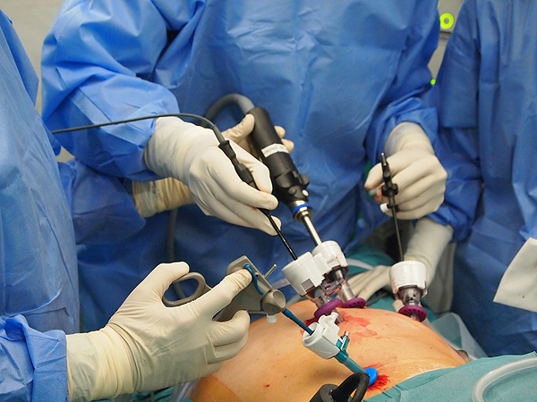 Una intervención quirúrgica por laparoscopia Fuente: Hospital del Mar 