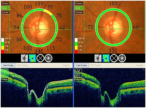Imagen relativa al glaucoma Fuente: Clinilaser / Acciones de Comunicación 