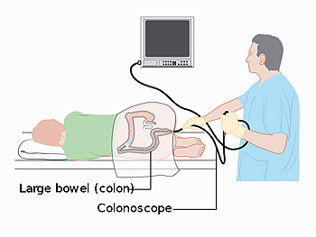 Una colonoscopia representada en una ilustración Autor/a de la imagen: Cancer Research UK Fuente: Wikimedia Commons 