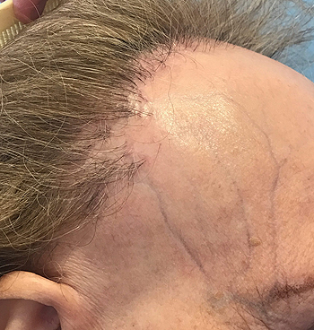 Alopecia frontal fibrosante Fuente: Dr. Vañó 
