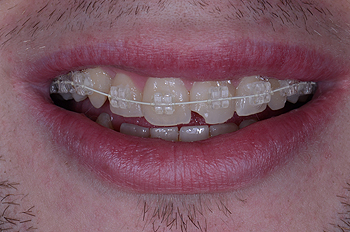 Aspecto de los ‘brackets’ de ortodoncia estética Autor/a de la imagen: Propdental  Fuente: Wikipedia 