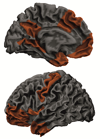 Representación del cerebro de una persona con psicopatía. Las zonas afectadas están destacadas  Fuente: Hospital del Mar 