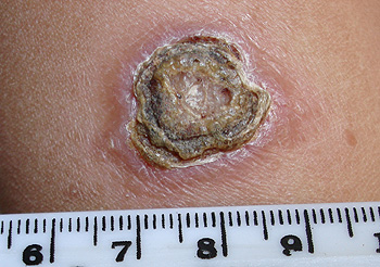 Lesión de la leishmaniosis cutánea Autor/a de la imagen: Abanima Fuente: Wikipedia 