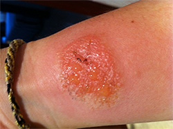 Dermatitis por contacto alérgica Fuente: Dra. Serra-Baldrich 