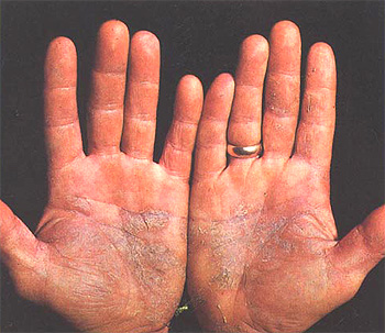 Placas de psoriasis en las palmas de las manos (imagen modificada) Autor/a del original: US Military - http://history.amedd.army.mil/booksdocs/wwii/internalmedicinevolIII/chapter20figure100.jpg Fuente: Wikipedia 