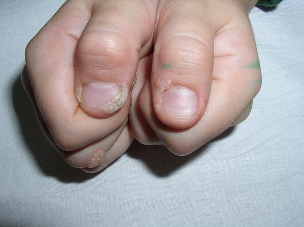 Verrugas en los dedos Fuente: Dr. De Lucas