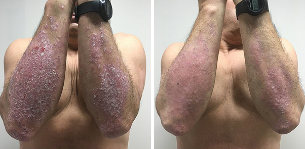 En la imagen de la izquierda, psoriasis antes del tratamiento con dimetilfumarato. A la derecha, después del tratamiento. El efecto se consiguió en 24 semanas