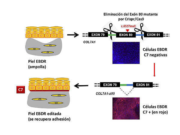 Descripción de la estrategia de edición genómica para la epidermólisis bullosa distrófica recesiva (EBDR): 1) La piel de un paciente con EBDR recrea el signo clave de la enfermedad cuando es trasplantada en la espalda de un ratón: fragilidad cutánea (ampollas) debido a la ausencia de la proteína colágeno 7. 2) Las células madre de la piel del paciente adquieren la capacidad de producir colágeno 7 en el momento que son editadas (se elimina el trozo del gen en el que se encuentra la mutación). 3) La piel editada (ahora productora de colágeno 7) es trasplantada a un ratón y se observa que se corrige la enfermedad (desaparecen las ampollas) Fuente: CIBER de Enfermedades Raras (CIBERER) 
