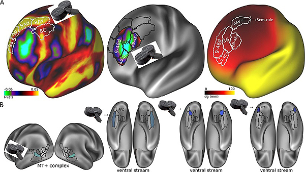 Dianas potenciales en regiones corticales visuales para el tratamiento con TMS (estimulación magnética transcraneal) basadas en el estudio de las conectividades que predicen la respuesta al tratamiento electroconvulsivo Fuente: CIBERSAM / Centro de Investigación Biomédica en Red (CIBER)  