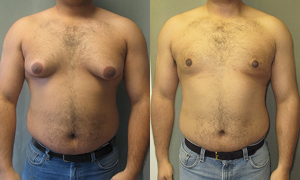 Comparación de un hombre con ginecomastia antes y después de una intervención Autor/a de la imagen: JMZ1122 Dr. Mordcai Blau www.cosmetic-md.com  Fuente: Wikipedia 