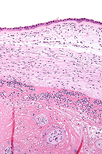 Micrografía mostrando corioamnionitis. Los acúmulos de manchas azules corresponden a células inflamatorias. Tinción hematoxilina-eosina Autor/a de la imagen: Nephron Fuente: Wikipedia 