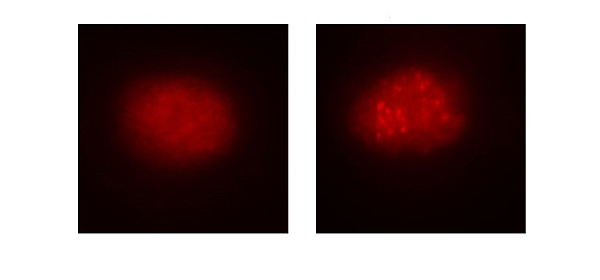 (A la izq.), célula de la sangre de un paciente con anemia de Fanconi antes de la corrección mediante el uso del sistema CRISPR/Cas9. (Dcha.), la célula ya corregida. Se observa cómo se repara la función de la ruta de la anemia de Fanconi Fuente: CIBERER / Centro de Investigación Biomédica en Red (CIBER) / CIEMAT / IIS-FJD