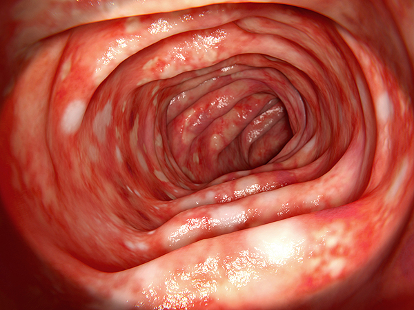 Colon afectado por colitis ulcerosa. Representación endoscópica en 3D Fuente: Archivo www.farmacosalud.com