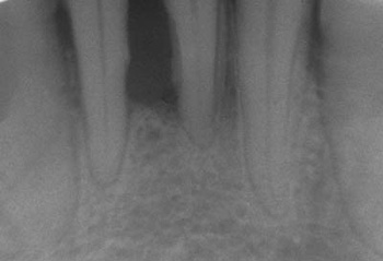 Esta radiografía muestra una pérdida significativa de hueso entre las dos raíces de un diente (zona en negro). El hueso esponjoso ha retrocedido debido a la infección debajo del diente, reduciendo su soporte óseo Fuente: Bernard bill5~commonswiki (Wikipedia) 