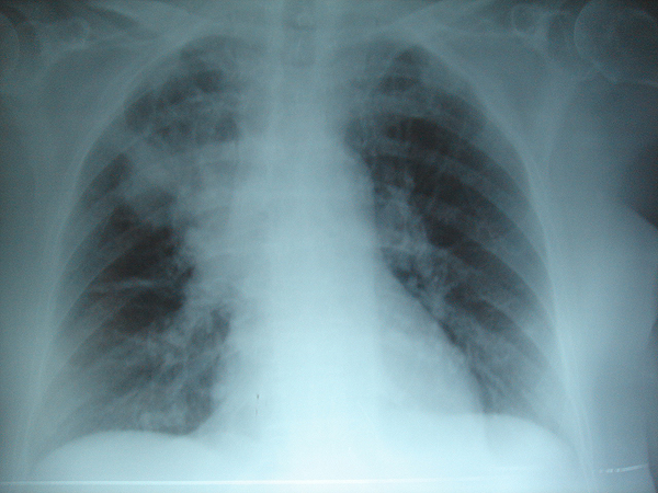 Neumonía apical derecha: en la FQ, la infección crónica da lugar a la destrucción del parénquima pulmonar, ocasionando por último la muerte por insuficiencia respiratoria