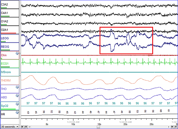 Síndrome de apnea-hipopnea durante el sueño - Wikipedia, la