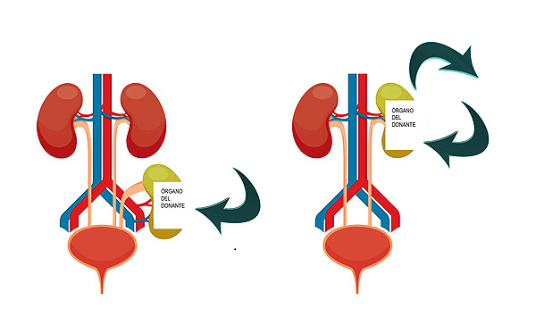 (infografía de la izquierda) Trasplante heterotópico, el más habitual: el nuevo riñón (el órgano del donante, aquí de color amarillo) se implanta en la fosa ilíaca  (imagen de la derecha) Trasplante ortotópico: se retira el riñón izquierdo del paciente -izquierdo si se ve desde la espalda del paciente- y en su lugar de implanta el nuevo riñón (el órgano del donante, aquí de color amarillo) (Imagen modificada) Fuente del original: Hospital de Bellvitge  